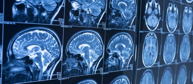 Study Compares Transgender, Cisgender Brain Scans