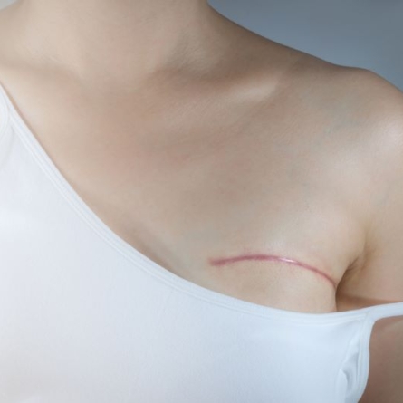 How Can Women Maintain Body Confidence and a Healthy Sexual Relationship After Mastectomy?